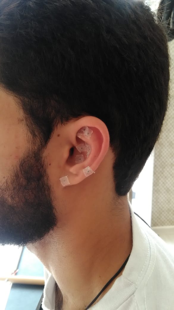 Paciente recebendo a aplicação de agulhas para tratamento com aculputura auricular